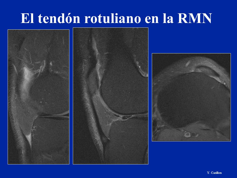 Sobre los últimos plazos del embarazo duele fuerte la espalda